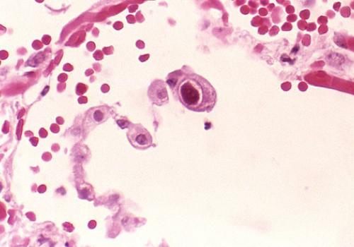 CMV infection of a lung  