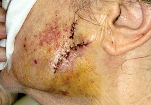 The pensioner shows the injuries she suffered in the attack